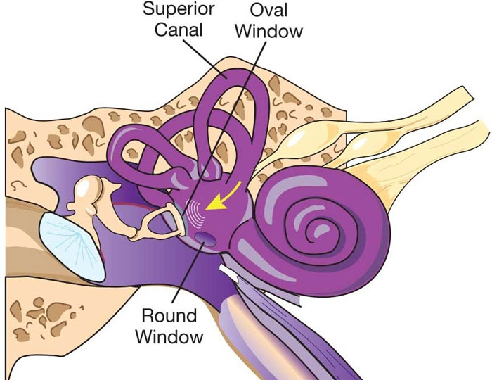 فیستول پری لنف