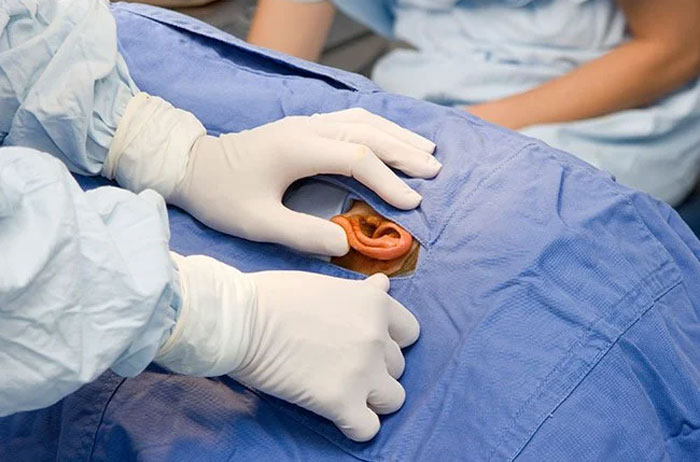 جراحی در اختلالات دهلیزی محیطی